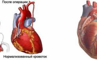 Как делают операцию шунтирование сердца видео