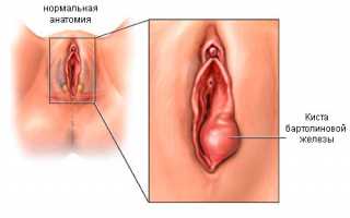 Варианты удаления кисты бартолиновой железы