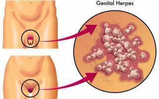 Вирус генитального герпеса и народное лечение его проявлений