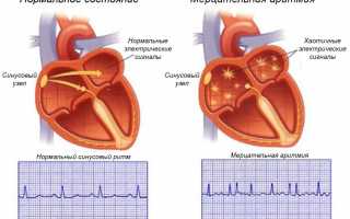 От чего бывает мерцательная аритмия сердца