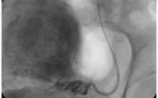Эмболизация маточных артерий противопоказания