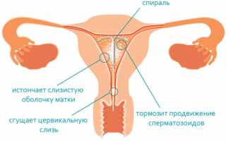 Вся необходимая информация о спирали Мирена, особенностях ее установки и использования