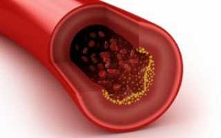 Как снизить холестерин в крови медикаментами